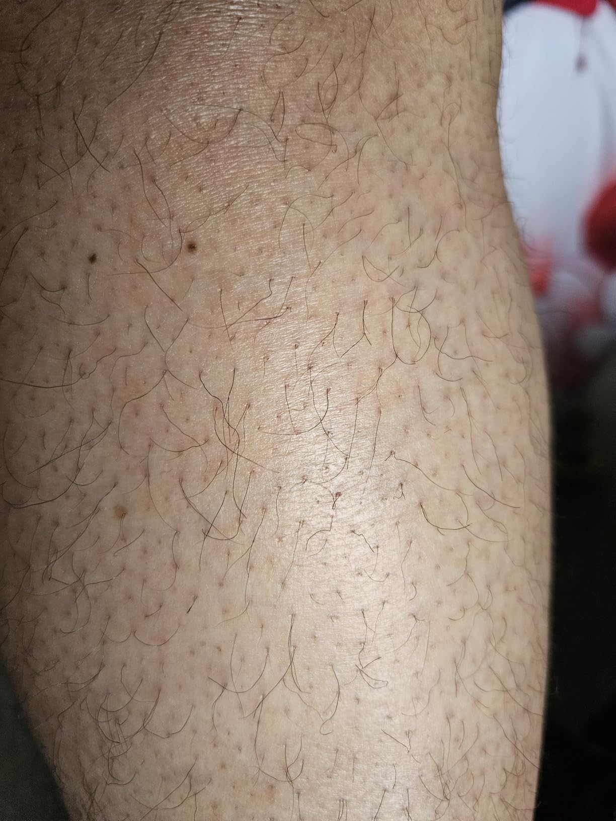 Ulike Laser Hair Removal Device Air 10 IPL for Women and Men, Ice Cool and Permanent Hair Reduction for Nearly Painless, Dual Lights, Skin Sensor & USHR Mode Hair Removal in 10mins from Home customer photo 2